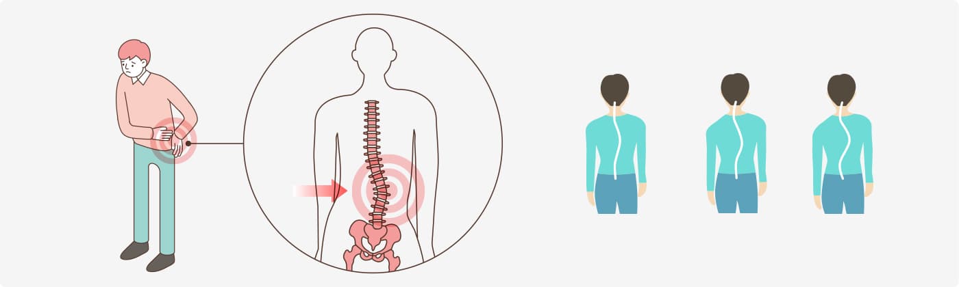 퇴행성 허리 측만증