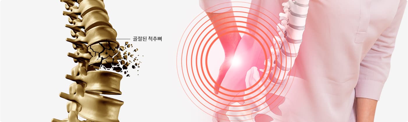 척추 압박골절